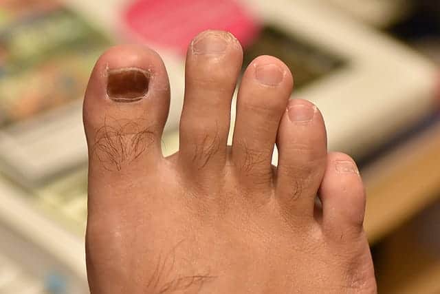 右足の親指　全体的に爪が黒くなった