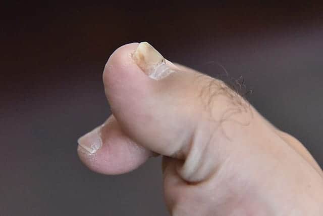 新しい爪が生えてきてる親指