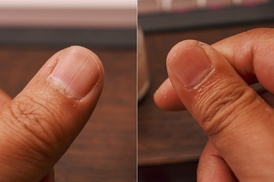 3年経過した親指の爪